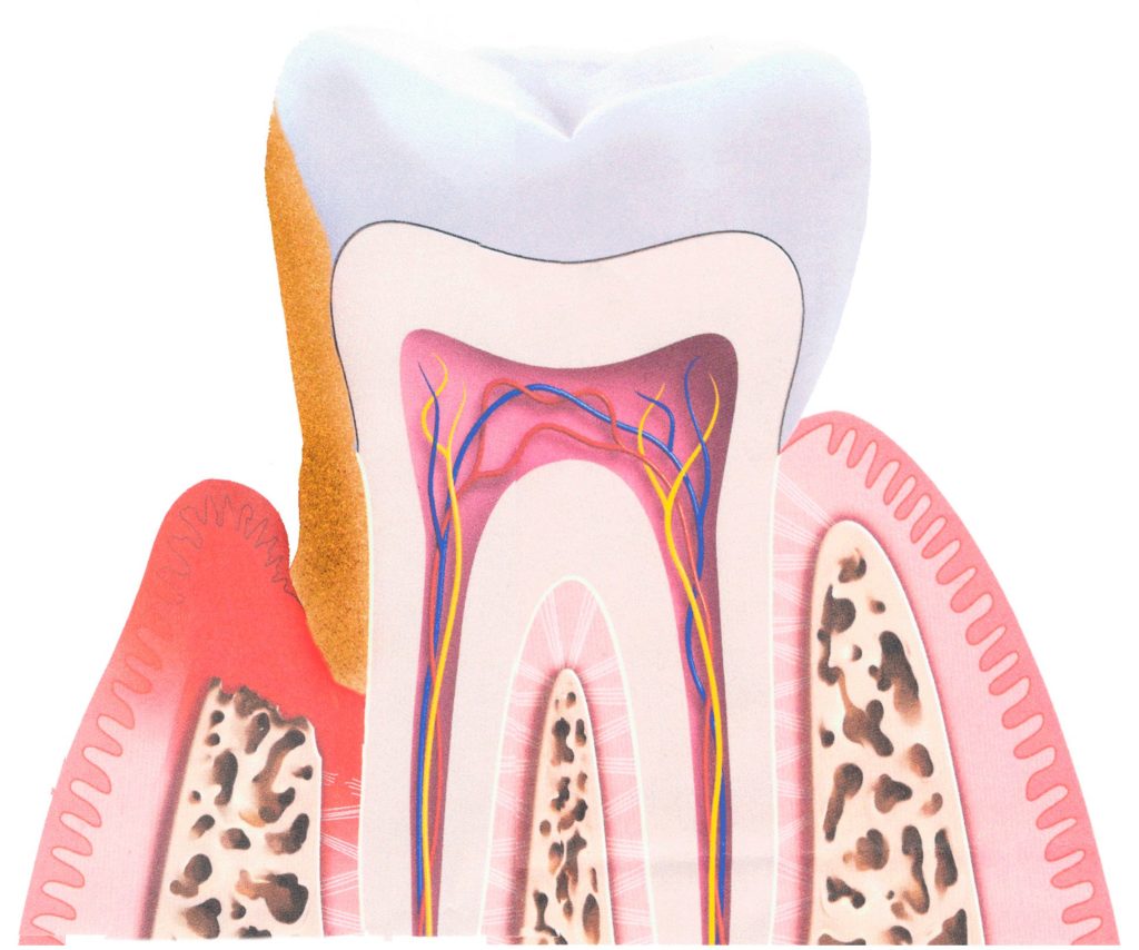 dente3