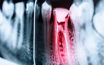 Dolore persistente e sensibilità? Quando devitalizzare è la scelta migliore per salvare il dente
