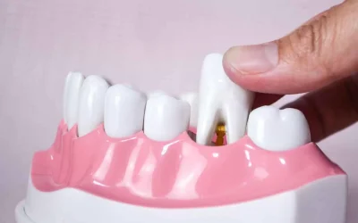 Dente da togliere? Quando l’estrazione è necessaria e perché non va rimandata