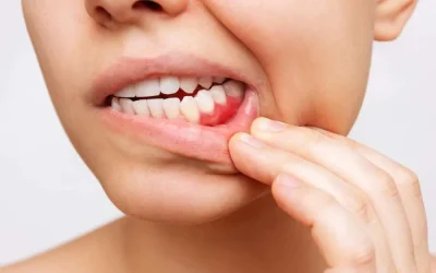 Parodontite: la malattia silenziosa che può mettere a rischio i tuoi denti