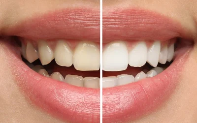 Macchie o denti spenti? Quando lo sbiancamento non è solo estetica
