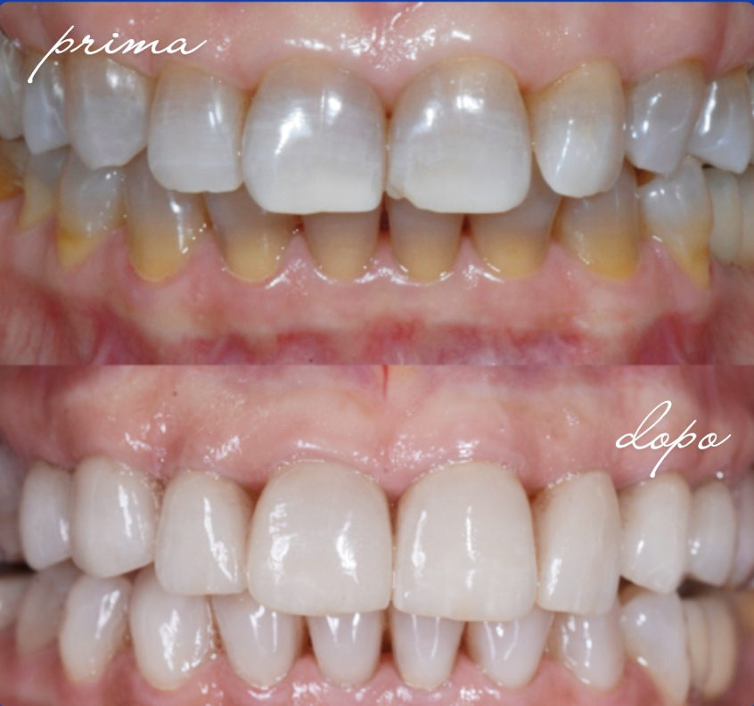 faccette-estetiche-dentali-brescia