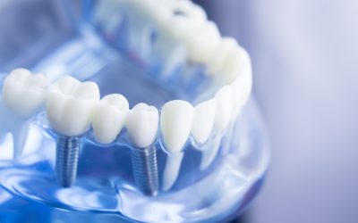 Implantologia a Brescia: denti fissi, sorriso ritrovato