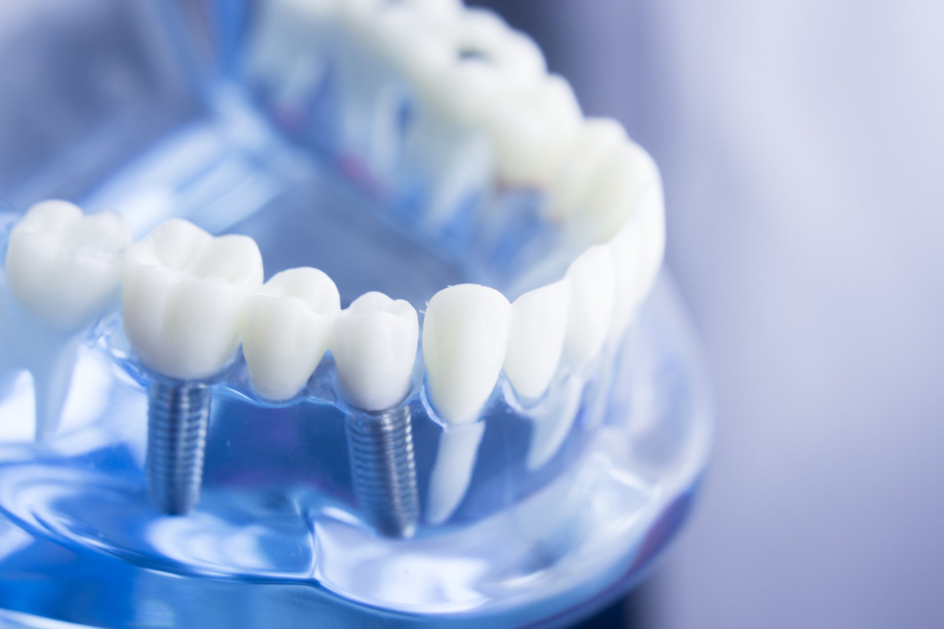 impianti-dentali-brescia