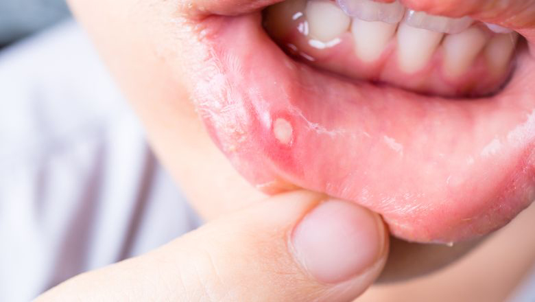 ozonoterapia-cura-delle-afte-brescia